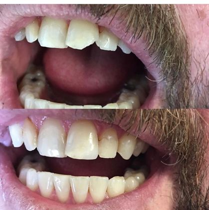 Click Here to See More Before & After Photos Dental Crown 4