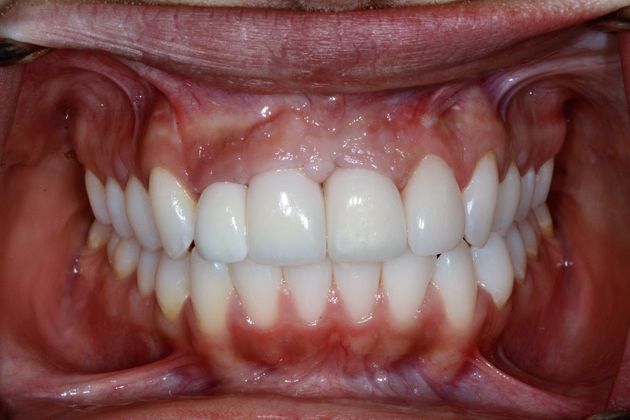 Dental Implants: Case 1 - Provisional Prosthesis