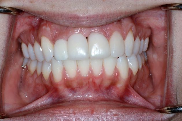 Dental Implants: Case 1 - Final Prosthesis