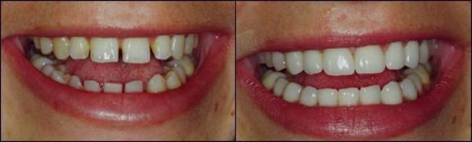 Porcelain Veneers: Case 4