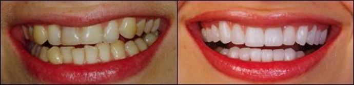 Porcelain Veneers: Case 5