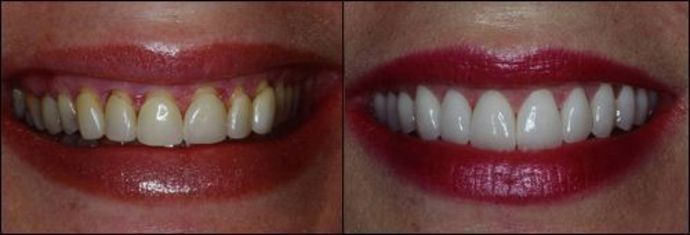 Porcelain Veneers: Case 6