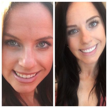 Porcelain Veneers: Case 1