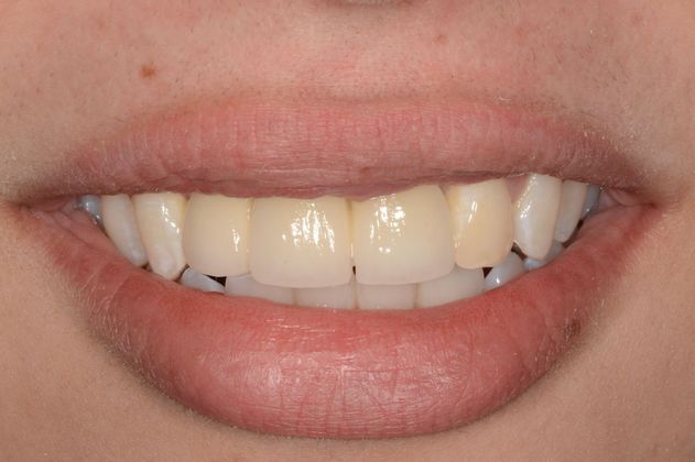 Dental Implants Case 1 - Before