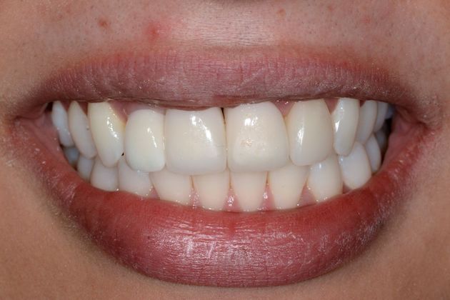 Case 1 - Dental Implants - Before and After Gallery