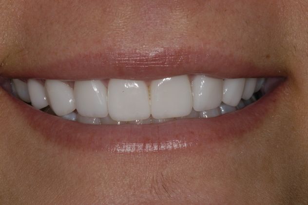 Porcelain Veneers Cases