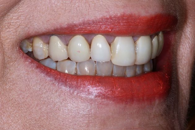 Porcelain Veneers: Case 6 - Before Right Side