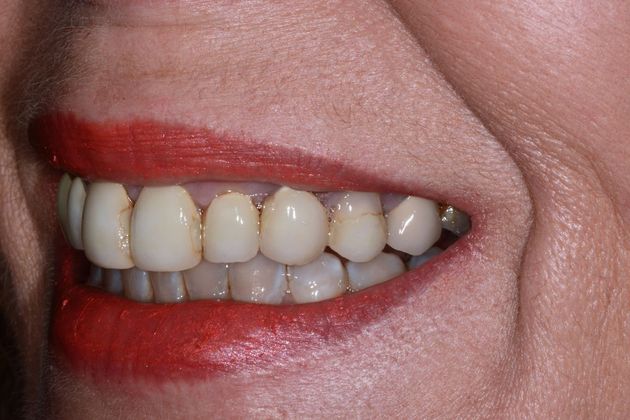 Porcelain Veneers: Case 6 - Before Left Side