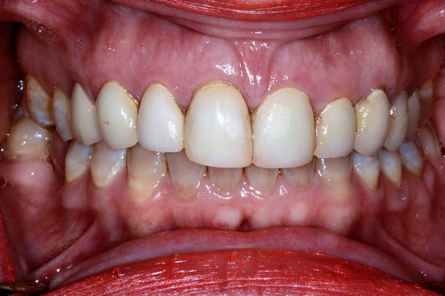 Porcelain Veneers: Case 6 - Before