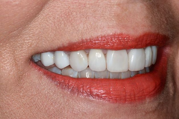 Porcelain Veneers: Case 6 - After Right Side