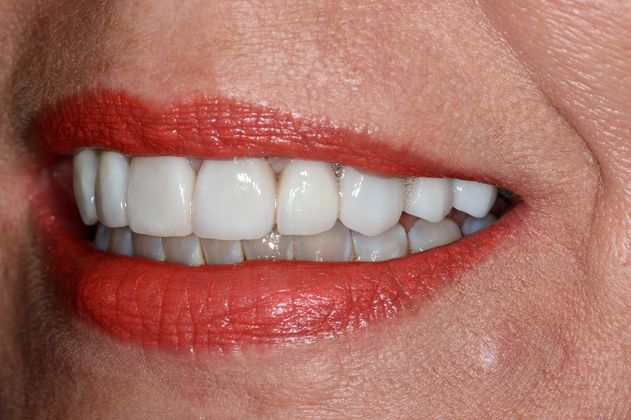 Porcelain Veneers: Case 6 - After Left Side