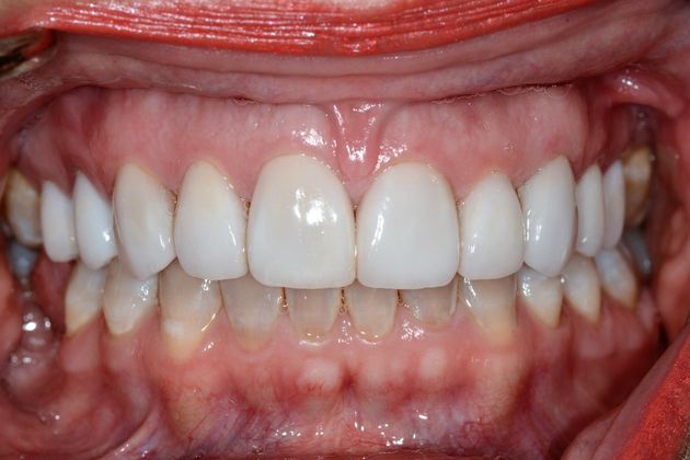 Porcelain Veneers: Case 6 - After