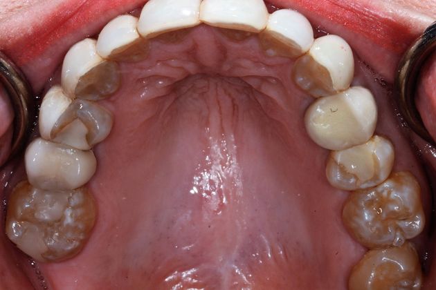 Porcelain Veneers: Case 6 - Before Occlusal