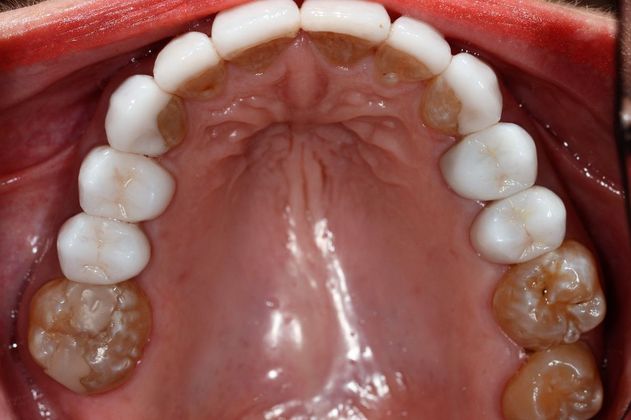 Porcelain Veneers: Case 6 - After Occlusal