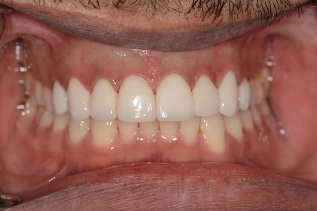 Cosmetic Dentistry: Case 1 - After