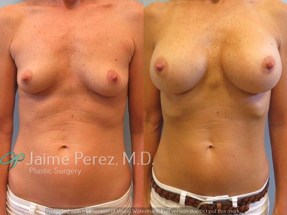 Breast Augmentation: 50 year old - Breast Augmentation - Before & After