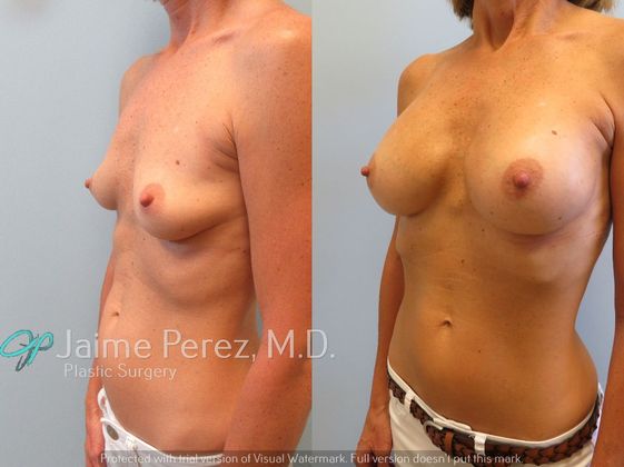 Breast Augmentation: 50 year old - Breast Augmentation - Before & After