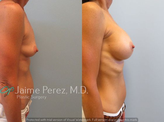 Breast Augmentation: 50 year old - Breast Augmentation - Before & After