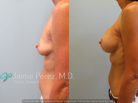 Breast Augmentation: 50 year old - Breast Augmentation - Before & After