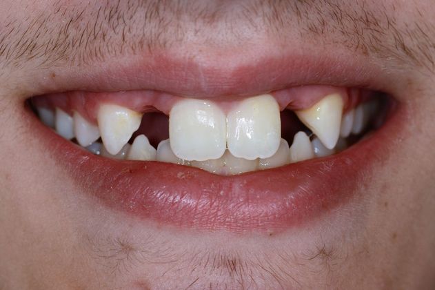 Maryland Bridges Case 1 - Before