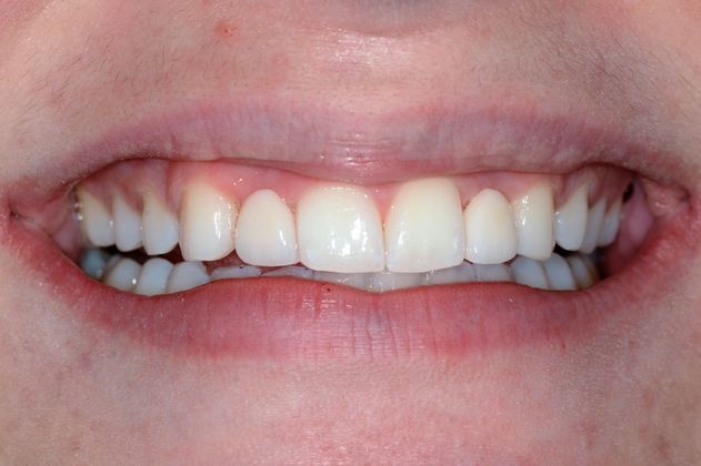 Maryland Bridges Case 2 - After