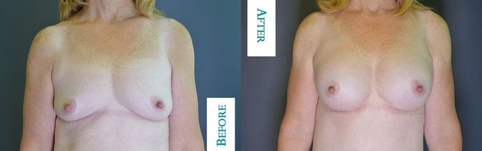 Breast Augmentation Case 26