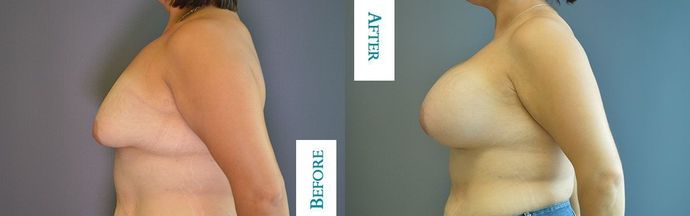 Breast Augmentation Case 27
