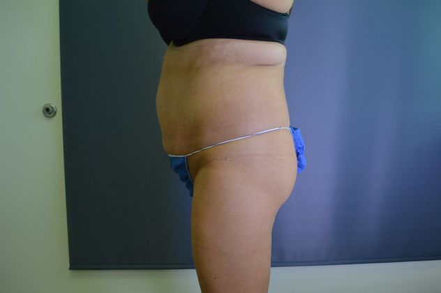 Liposuction Case 11 - Before