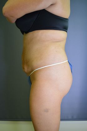 Liposuction Case 11 - After