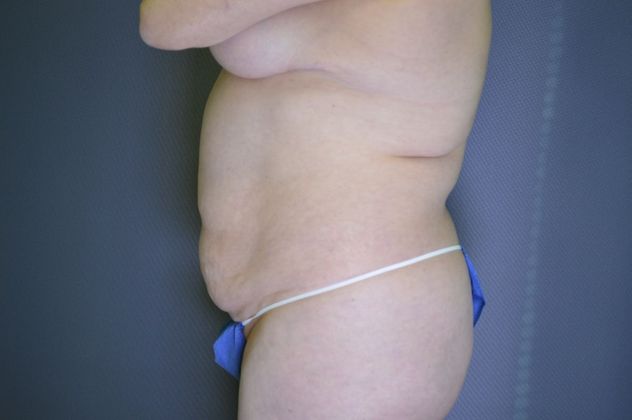 Liposuction Case 12 - Before