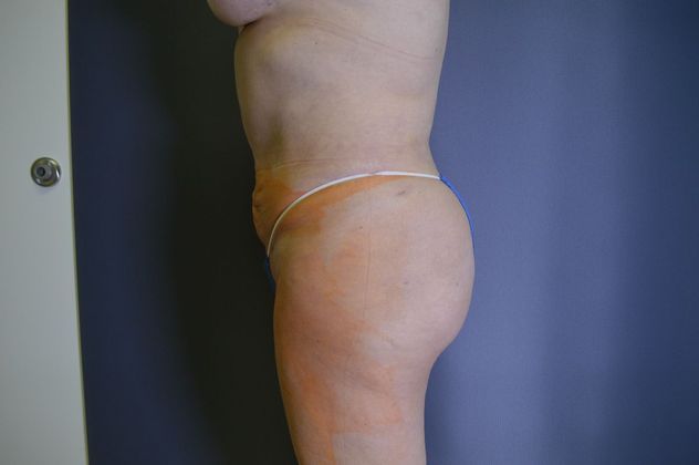 Liposuction Case 12 - After