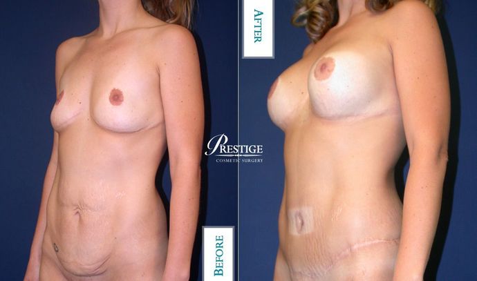 Mommy Makeover: Case 3 - Before & After