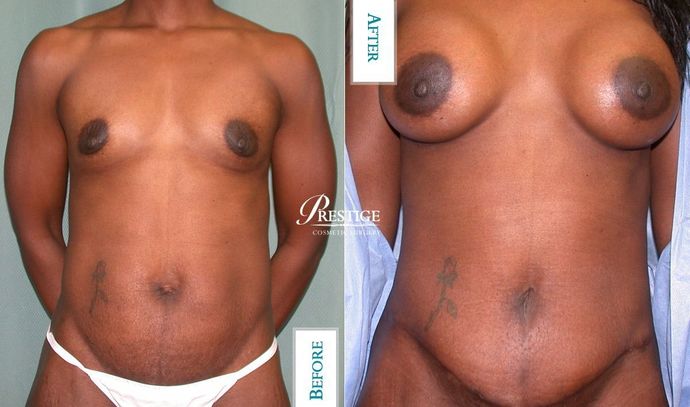 Mommy Makeover: Case 4 - Before & After