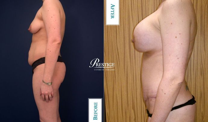 Mommy Makeover Case 5