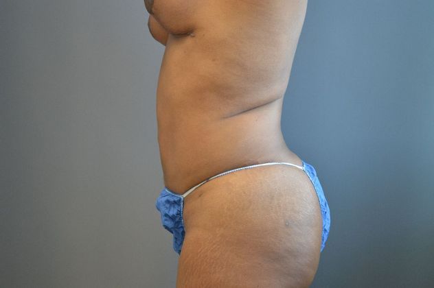 Brazilian Butt Lift Case 4 - After