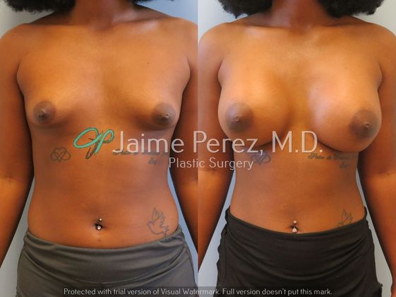 Breast Augmentation: 23 year old - Circumareolar approach - Before & After