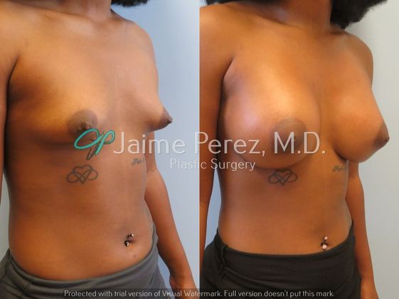 Breast Augmentation: 23 year old - Circumareolar approach - Before & After