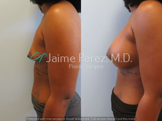 Breast Augmentation: 23 year old - Circumareolar approach - Before & After