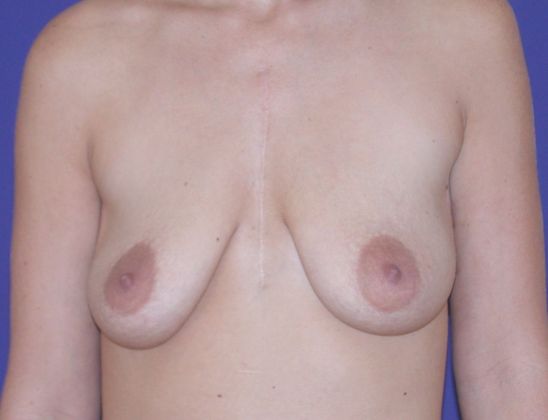 Breast Lift Case 20 - Before