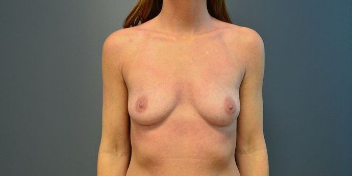 Breast Augmentation Case 28 - Before