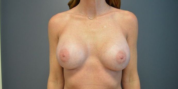 Breast Augmentation Case 28 - After