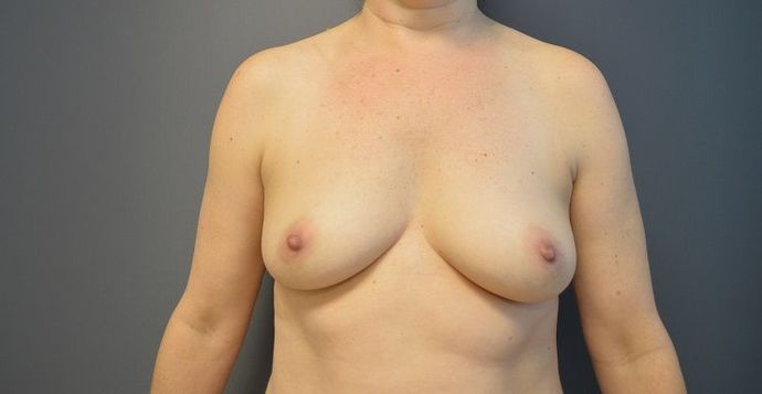 Breast Augmentation Case 15 - Before