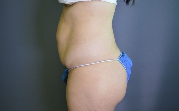 Liposuction Case 13 - Before