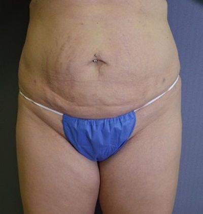 Tummy Tuck Case 6 - Before