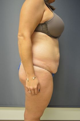 Tummy Tuck Case 7 - Before