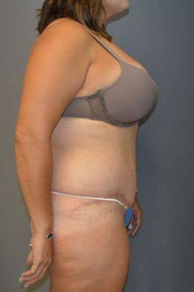 Tummy Tuck Case 7 - After