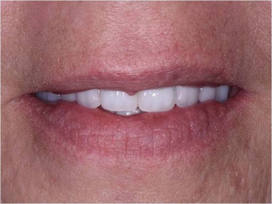 Full Mouth Rehabilitation with Dental Implants Cases