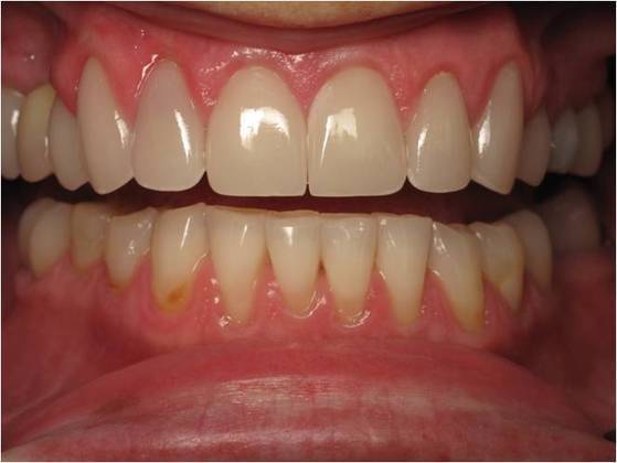 Cosmetic Crowns Cases