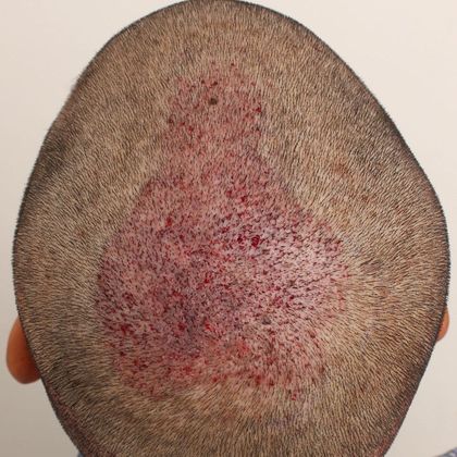 Male Before and After Crown Hair Restoration Photos: Crown (4) - Post-op FUE procedure day
