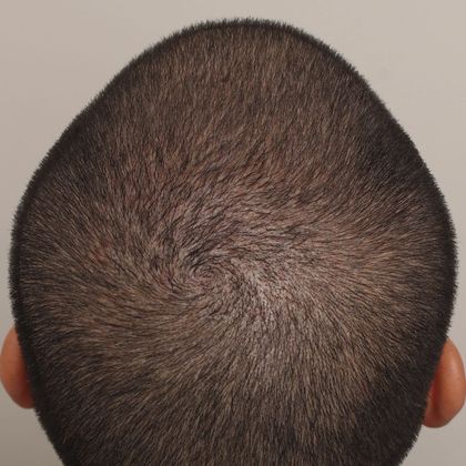 Crown (4) - Male Before and After Crown Hair Restoration Photos ...